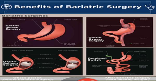 Benefits of Bariatric Surgery Infographic Infographics | Medicpresents.com