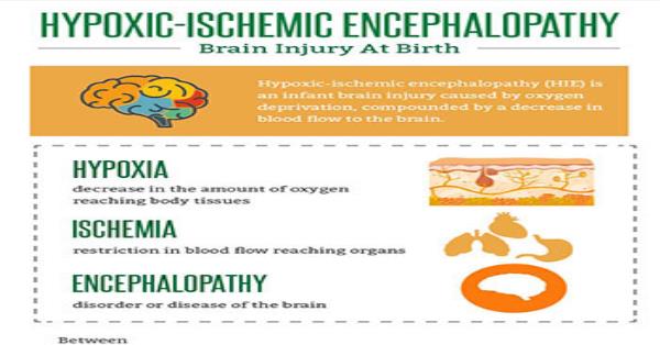 Hypoxic-ischemic Encephalopathy - Brain Injury at Birth Infographic ...