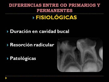 Pulp treatment in primary dentition