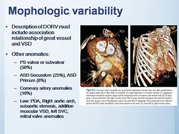 Double Outlet Right Ventricle (DORV)