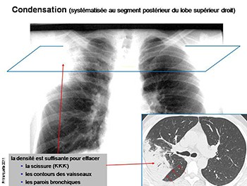 Syndromes Alveolaires