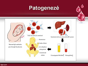 Neonatal Hemolytic Disease