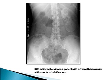 Tuberculosis of Urinary Tract