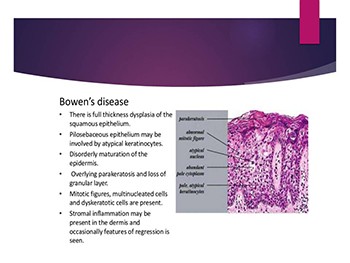 Bowens Disease