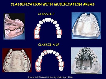 Classification and Components of Removable Partial Denture Parts