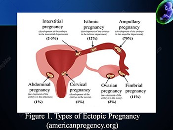 Risk of Ectopic Pregnancy