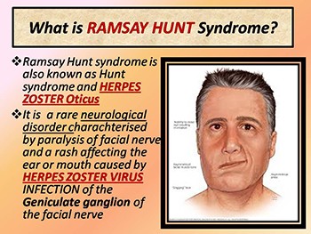 Ramsay Hunt syndrome