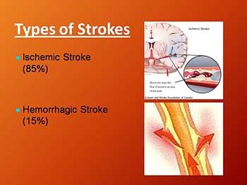 Cerebral Vascular Accident