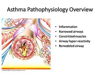 Pediatric Asthma