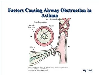 Asthma