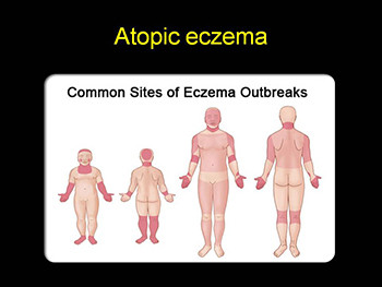 Atopic Eczema