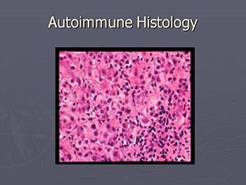 Autoimmune Hepatitis