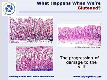 Celiac Disease - The Gluten-Free Diet and The Prevention of Cross-Contamination