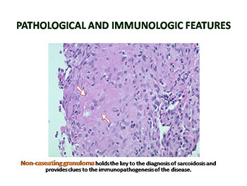 Ocular manifestations of sarcoidosis