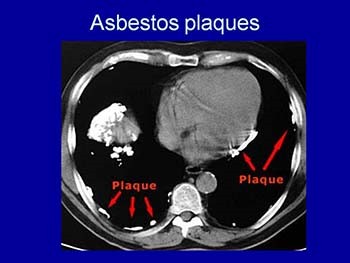 Occupational Lung Diseases