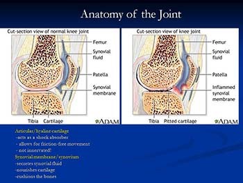 Rheumatoid Arthritis