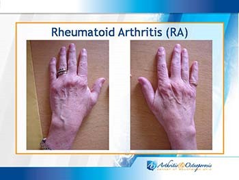 Rheumatoid Arthritis Treatment options