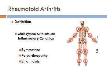 Rheumatoid Arthritis Vs Osteoarthritis