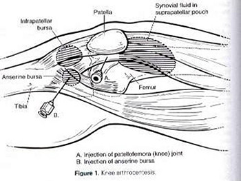 Gout and Pseudogout