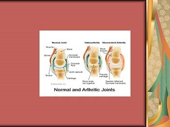 Rheumatoid Arthritis An Autoimmune Mystery