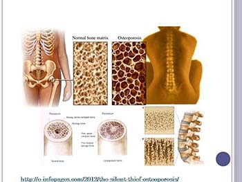 Osteoporosis