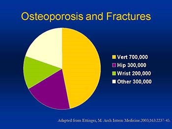 Osteoporosis Bad to the Bone