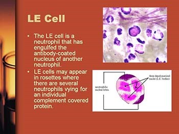 Systemic Lupus Erythematosus