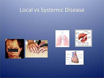 Scleroderma and the Kidney