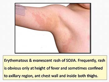 Juvenile Idiopathic Arthritis (JIA)