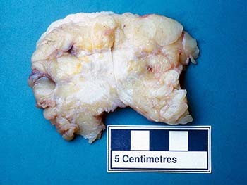 Histopathology and staging of breast cancer