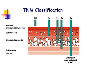 Gastrointestinal Cancer