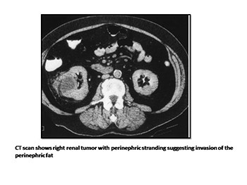 Renal Cell Carcinoma