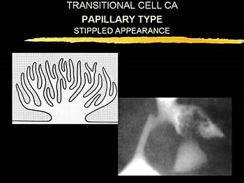 UROEPITHELIAL TUMORS