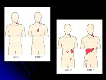 About Non Hodgkins lymphoma (NHL)