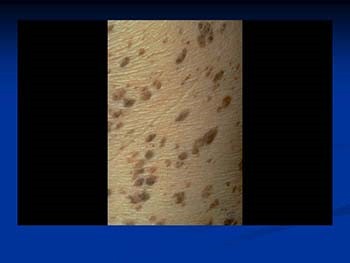 Skin Tumors Benign and Malignant
