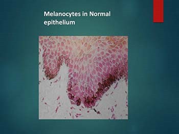 Disorders of Melanocytes Melanoma