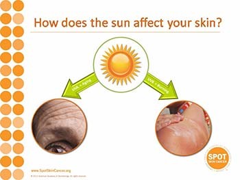 Skin Cancer - You can prevent it!