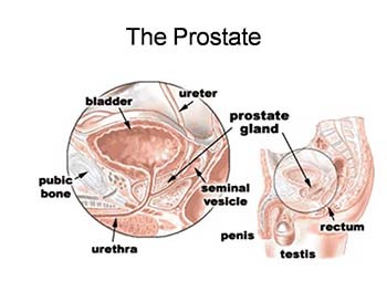 Prostate Cancer: Diagnosis and Prevention