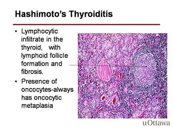 Thyroid Pathology