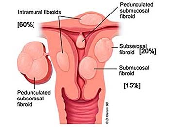 UTERINE FIBROIDS (LEIOMYOMATAS)