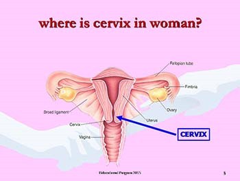 CERVICAL CANCER and ITS PREVENTION