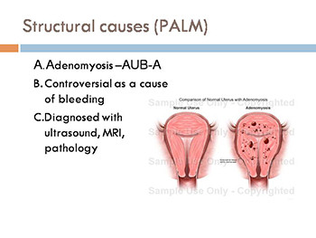 Abnormal Uterine Bleeding