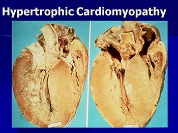 Cardiomyopathy