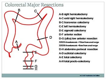 Colorectal Cancer Surgery