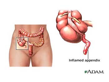 Appendicitis