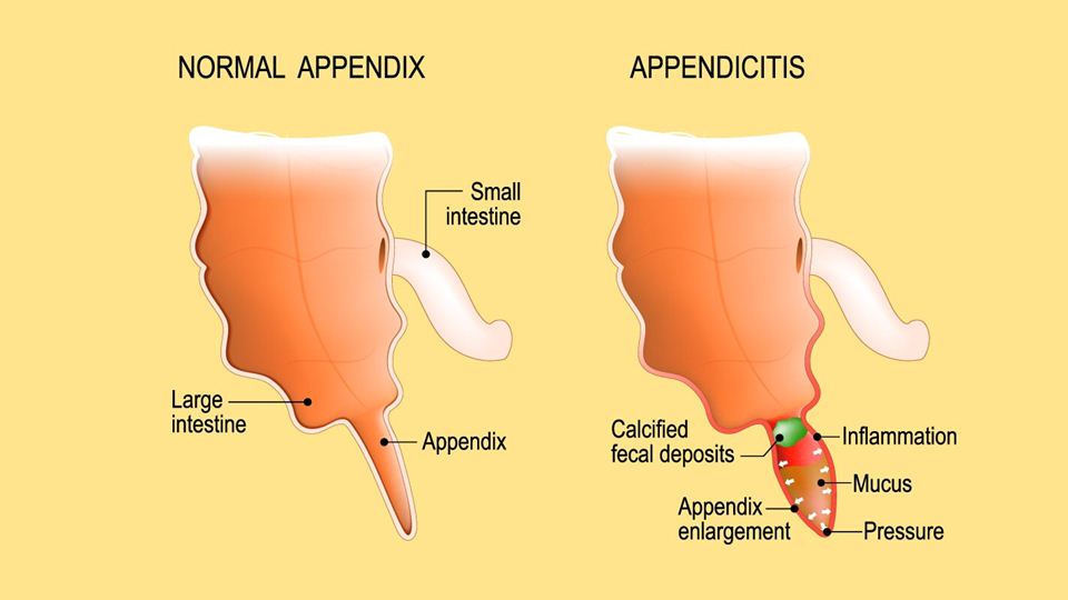 Mcburney Incision Ppt