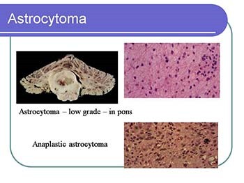 Brain tumors