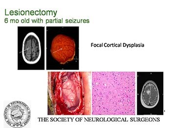 Pediatric Neurosurgery