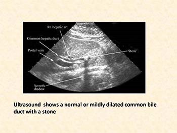 CBD Stones Stricture Carcinoma Gall Bladder Cholangiocarcinoma