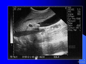 Bedside Ultrasound of the Biliary Tract